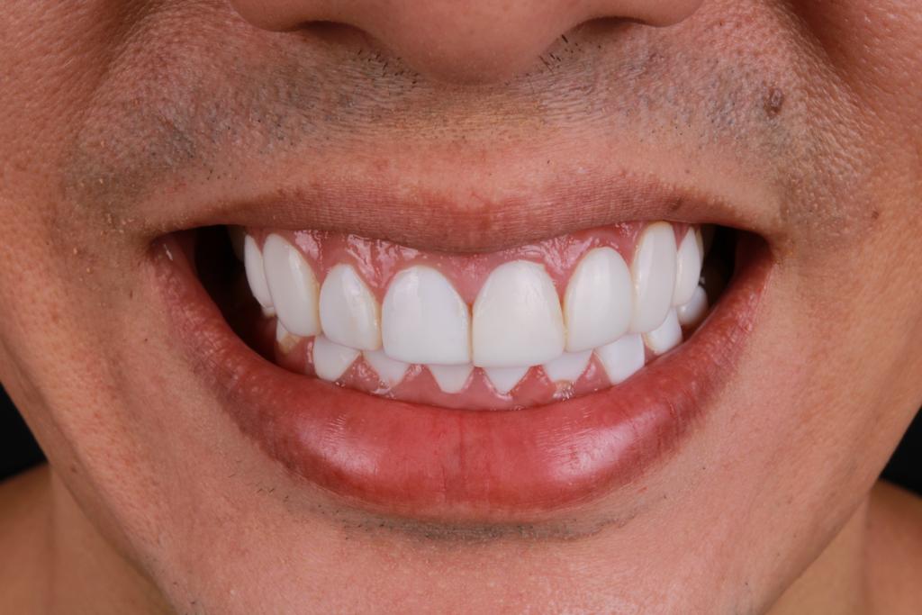 Antes diseño dental